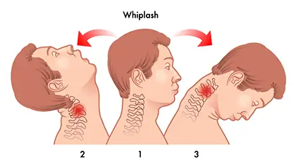 A diagram of whiplash injury