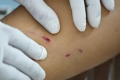 Close-up of dog bite marks being examined on an injured leg