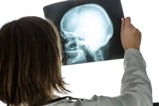 Traumatic Brain Injuries (TBIs) in Imperial County
