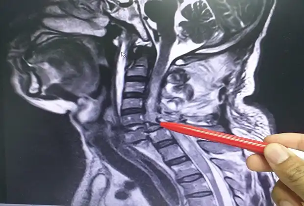 Radiografía De Fractura De Columna Vertebral Tras Un Accidente En North Hollywood