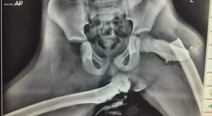 X-ray showing severe hip dislocation injury from crash with feet on dashboard