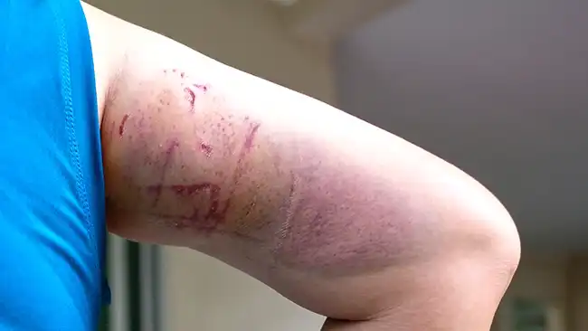 Bite injuries caused by a dog attack in Bakersfield