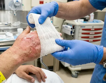 Restaurant burn injury medical treatment