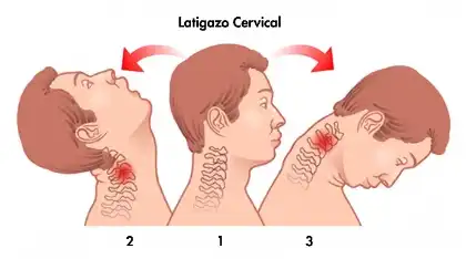 Un esquema de la lesión por latigazo cervical